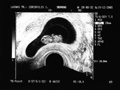 Endometrial clinical pregnancy at 8 weeks. The embryo is visible using transvaginal ultrasound.